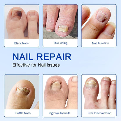 Advanced Fungal Nail Patch